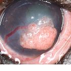 carcinome epidermoide 1